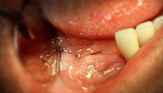 Before installing dental implants