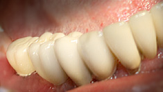 Dental implants end result: Τελικό αποτέλεσμα: ευχάριστο χαμόγελο, άνεση στο μάσημα. Dental Clinic Vident, Nicosia Cyprus.