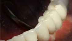 Dental implants installed in Dental Clinic Vident, Nicosia Cyprus